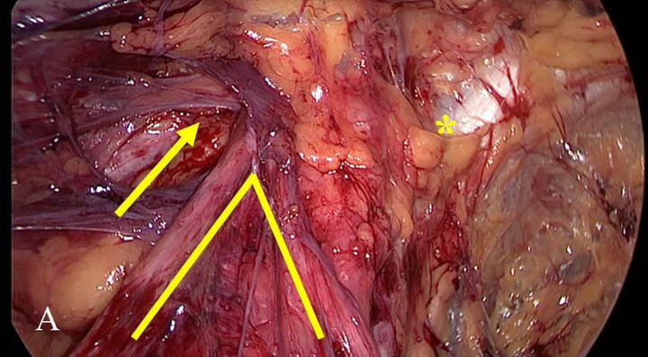 Inguinalhernie.jpg Blick von innen auf einen Leistenbruch.